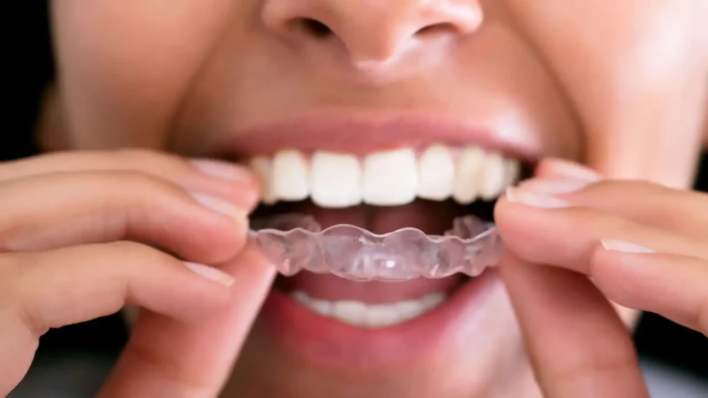 Teeth Grinding And Tmj: A General Dentist’s Perspective Teeth